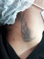 Borrado de tatuajes con Láser - Imagen 7
