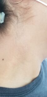 Borrado de tatuajes con Láser - Imagen 3