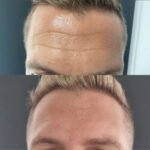 3 zonas Rostro con Toxina Botulínica Premium Hombre o Mujer - Imagen 3