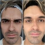 3 zonas Rostro con Toxina Botulínica Premium Hombre o Mujer