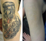Borrado de tatuajes con Láser - Imagen 4
