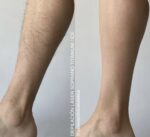 Depilación Láser Piernas Completas (XL) + Rebaje Completo (M) + Glúteos (L) Hombre - Imagen 5