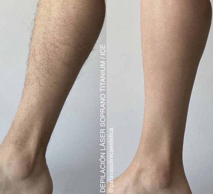 Depilación Láser Piernas Completas (XL) + Rebaje Completo (M) + Glúteos (L) Hombre - Imagen 5