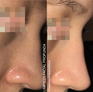 2x1 Limpieza Glow Facial - Imagen 6