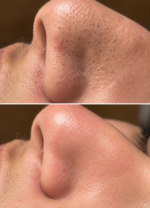 Limpieza Facial Korean Clear Skin - Imagen 2