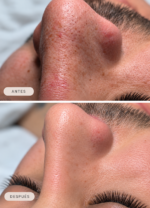Limpieza Facial Korean Clear Skin - Imagen 3