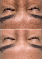 Limpieza Facial Korean PDRN Skin Renewal - Imagen 2