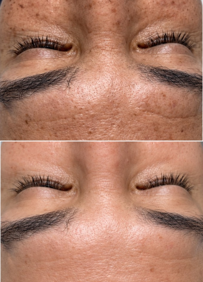 Limpieza Facial Korean PDRN Skin Renewal - Imagen 2