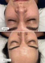Carbon Peel + Vitaminas con microneedling - Imagen 4