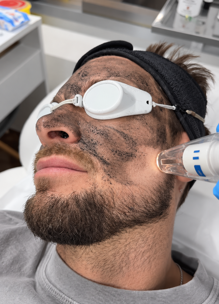 Carbon Peel + Vitaminas con microneedling - Imagen 3